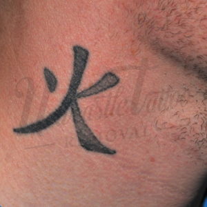 Chinese Neck Tattoo Before Treatment