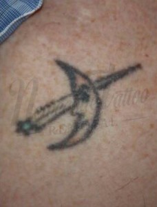 Moon Tattoo Before Newcastle Tattoo Removal